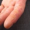 Eczeem handen - Stofwisseling en huid - Realisaties