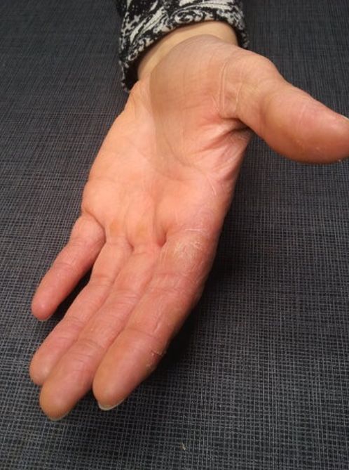 Eczeem handen - Stofwisseling en huid - Realisaties