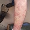 Psoriasis - Stofwisseling en huid - Realisaties